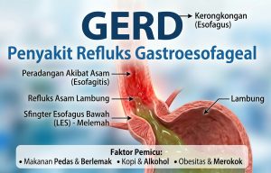 GERD