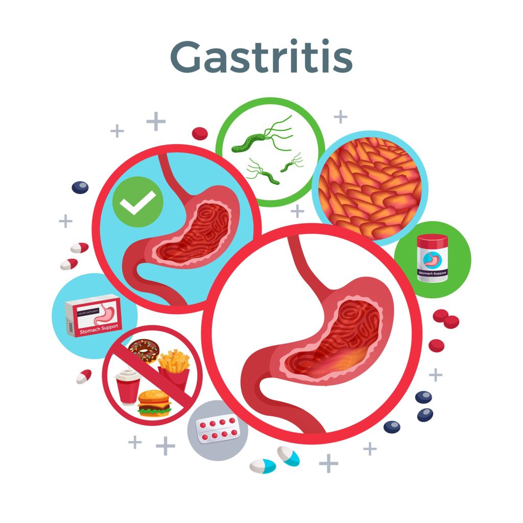GASTRITIS